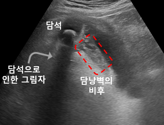 0173d39e03c63763d879253c5596650c_1732269168_6683.png 담석과 담낭벽 비후를 표시한 복부 초음파 영상