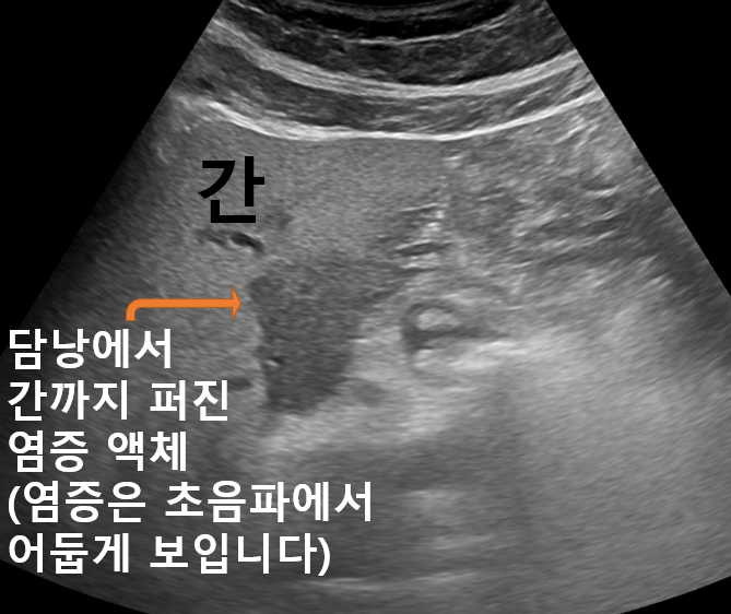 0173d39e03c63763d879253c5596650c_1732269183_5148.png 담낭 주변 염증 소견을 설명하는 복부 초음파 영상