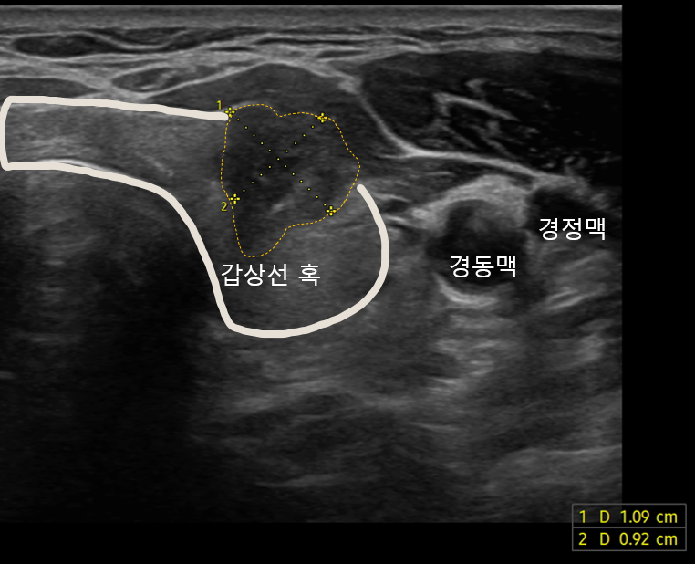 갑상선 결절과 주변 혈관의 위치를 표시한 초음파 영상