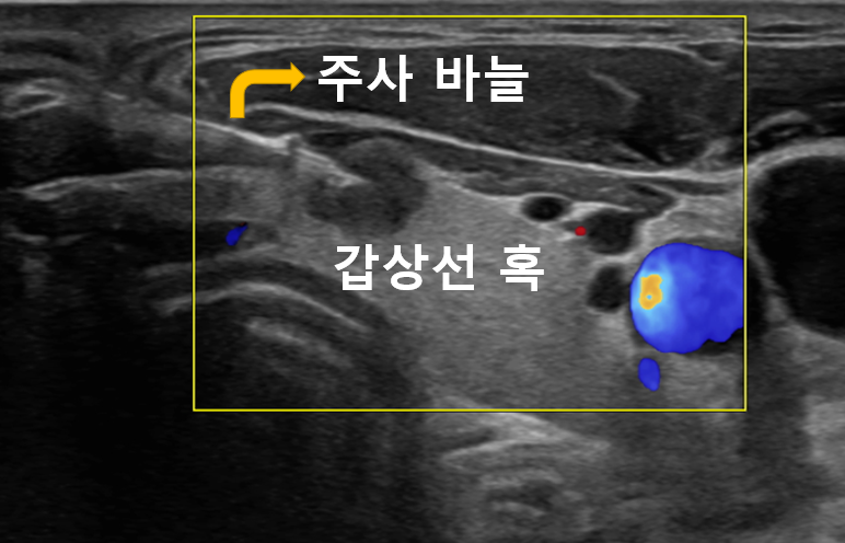 갑상선 결절 세침검사 바늘 위치를 표시한 영상