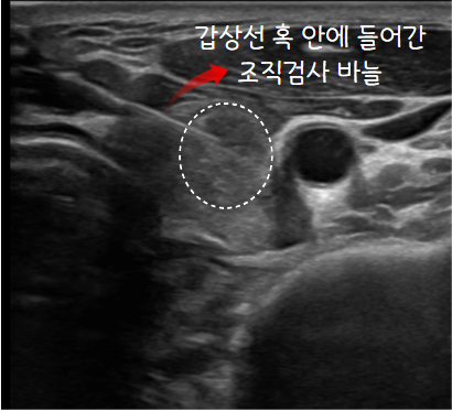 0209ea47bc8edddbe91f34d8ad647ac6_1737534523_5239.png 갑상선 결절 조직검사 바늘 위치를 표시한 초음파 영상
