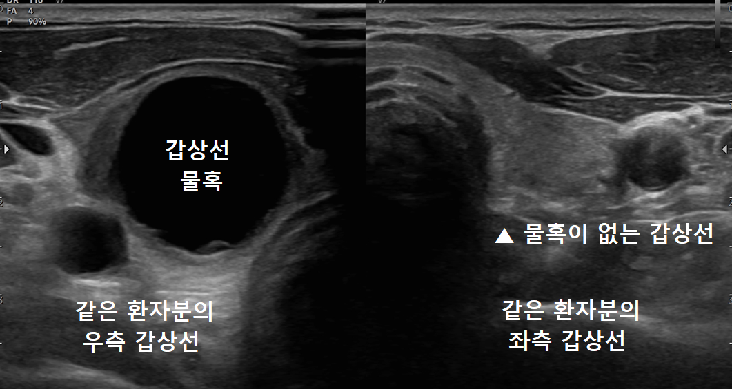 낭종이 있는 갑상선과 반대쪽 갑상선 비교