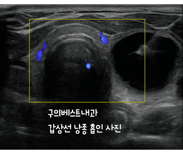 갑상선 낭종 흡인 과정을 보여주는 초음파 영상