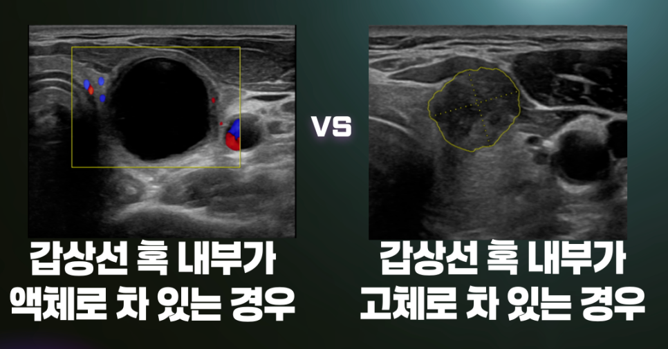 액체가 찬 낭종과 고형 갑상선 결절의 초음파 비교