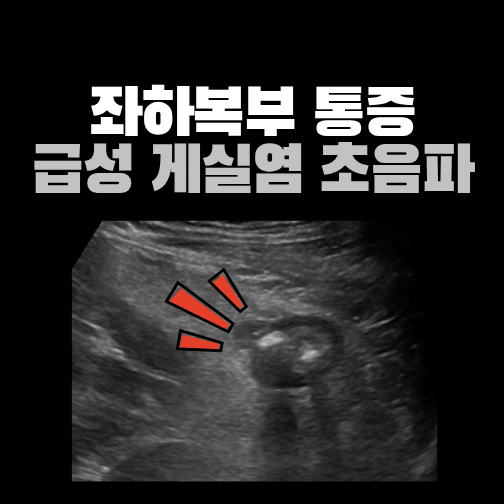 왼쪽 아랫배 통증이 계속될 때, 초음파로 확인한 급성 게실염