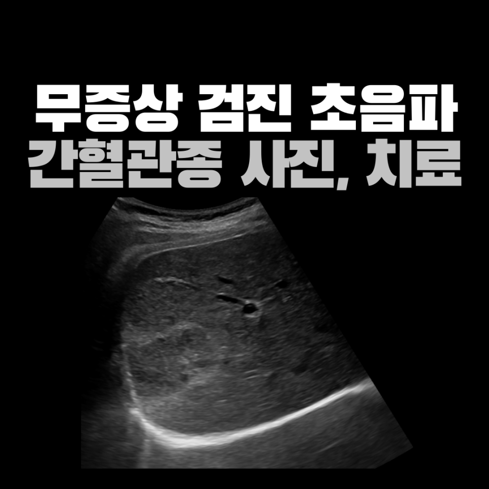증상 없이 발견된 약 4cm 간 병변, 초음파에서 혈관종을 의심한 이유