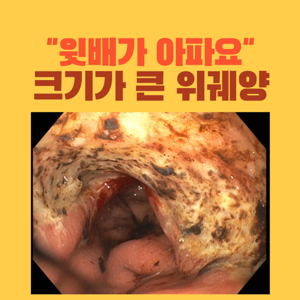 쥐어짜는 듯한 윗배 통증, 위내시경에서 확인한 넓고 깊은 위궤양
