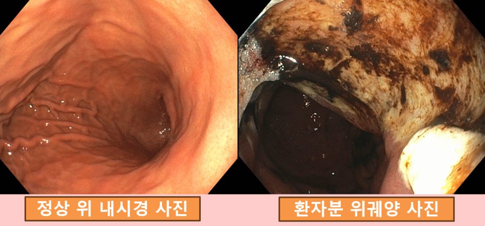 다른 각도에서 본 일반 위 점막과 검은 부착물이 보이는 환자의 위궤양 비교 사진