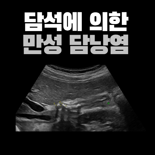 담석에 의한 만성 담낭염 초음파 영상이 들어간 원본 표지