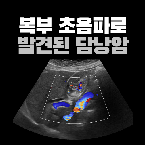 소화불량으로 내원해 발견한 담낭 종괴, 초음파에서 암을 의심한 이유