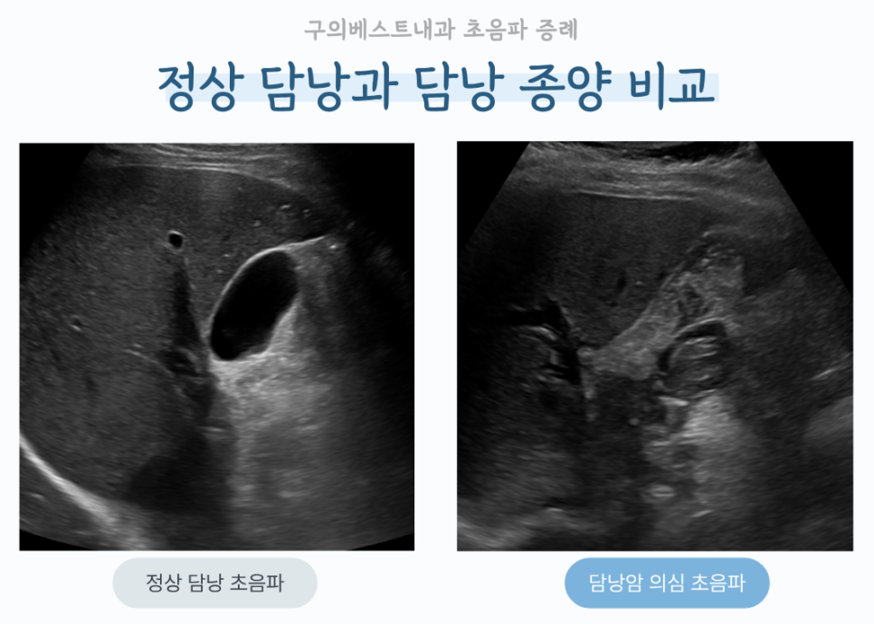 종괴가 없는 담낭과 종괴가 담낭 안을 채운 초음파 영상을 나란히 보여주는 비교 사진