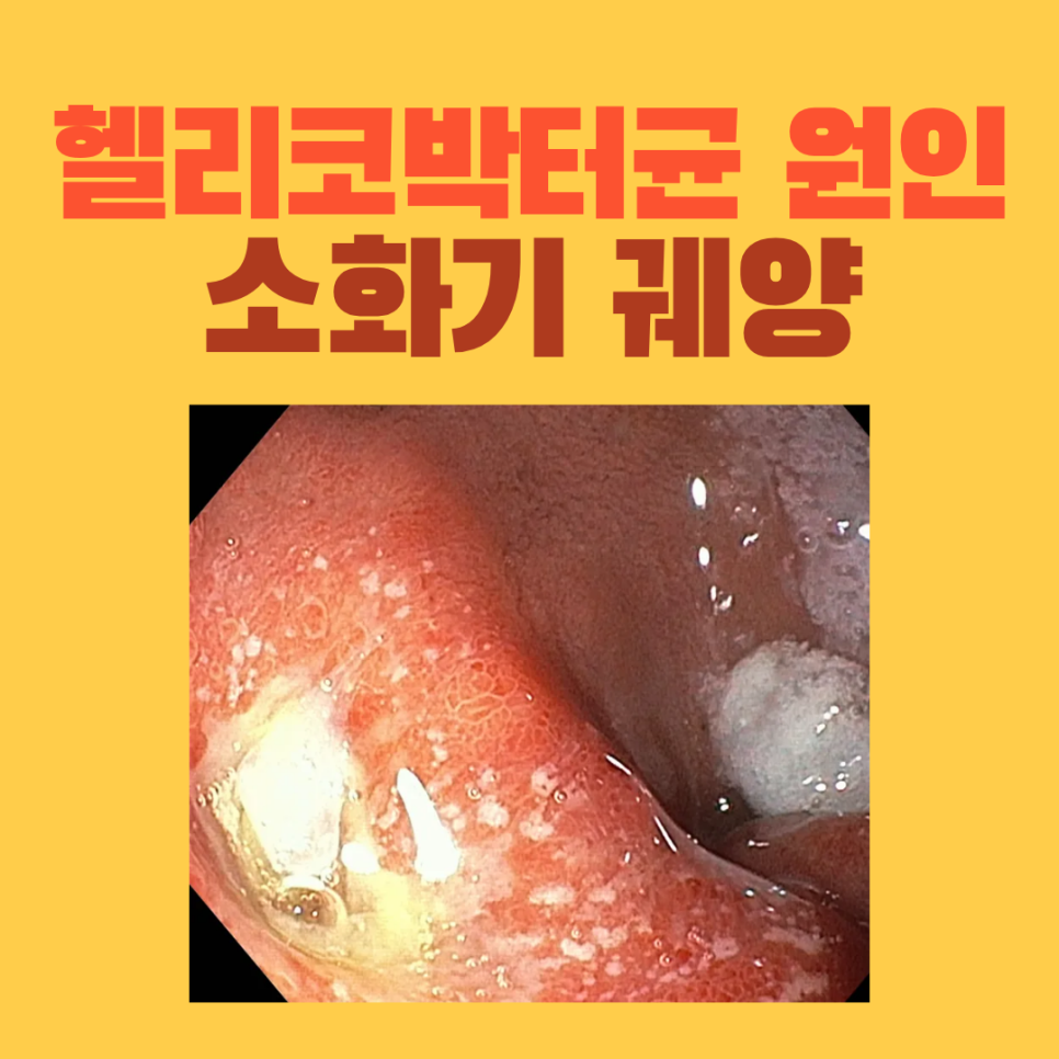 윗배 통증과 과거 헬리코박터 감염 병력, 위미란·십이지장궤양을 확인한 내시경