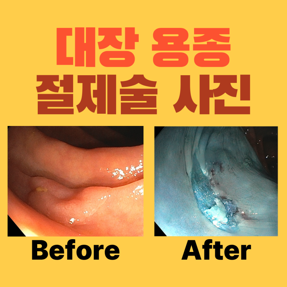 첫 대장내시경에서 발견한 약 1cm 용종, 절제와 조직검사까지