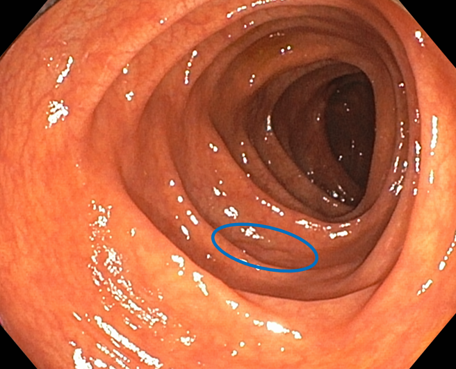 대장 점막의 용종 위치를 표시한 내시경 영상
