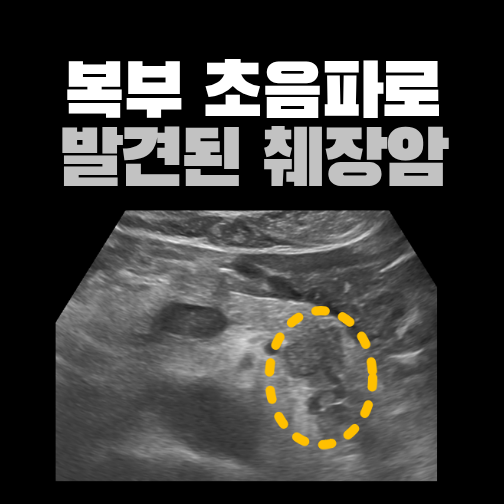 소화불량과 왼쪽 윗배 통증, 초음파에서 발견한 췌장 꼬리의 종괴