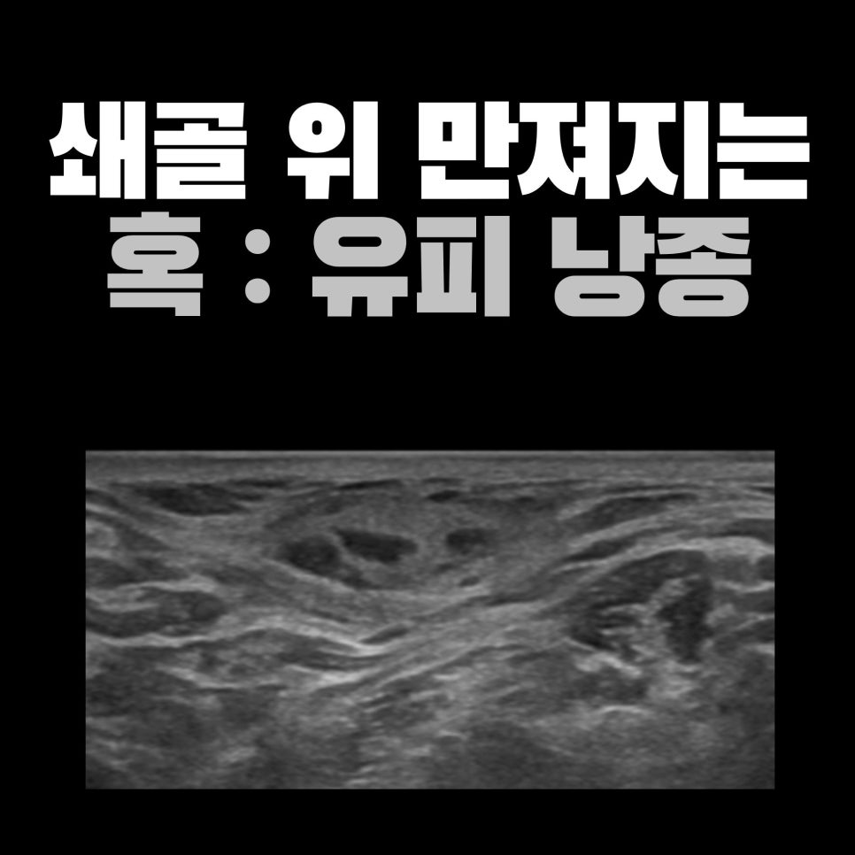 우측 쇄골 위에 만져진 혹, 경부 초음파에서 유피낭종을 의심한 사례