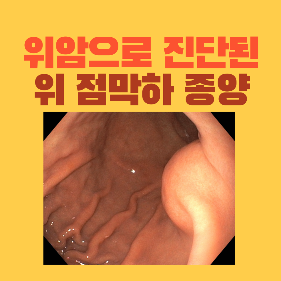 증상 없이 발견된 위점막하종양, 수술 후 GIST로 확인된 사례