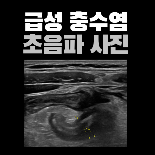 오른쪽 아랫배가 아닌 옆쪽 복통, 초음파로 확인한 맹장 뒤 충수염