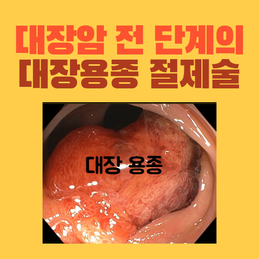 첫 대장내시경에서 발견한 큰 줄기형 용종, 절제 후 고위험 선종으로 확인