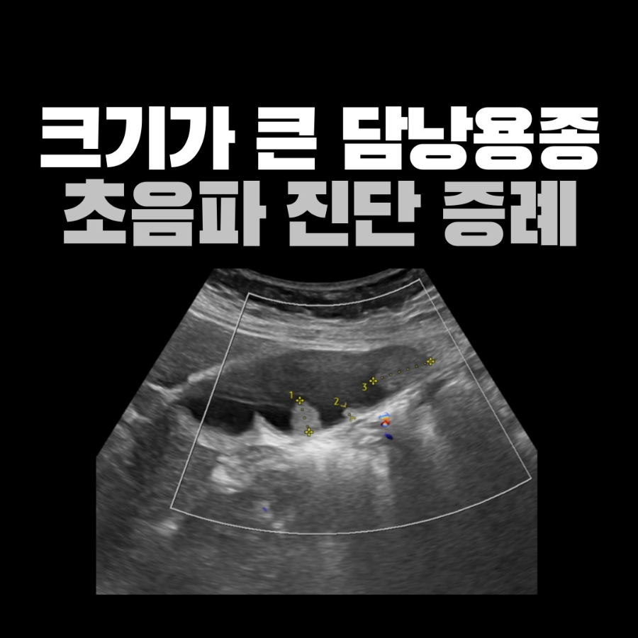 증상 없이 받은 복부초음파에서 발견한 1cm 이상 담낭용종