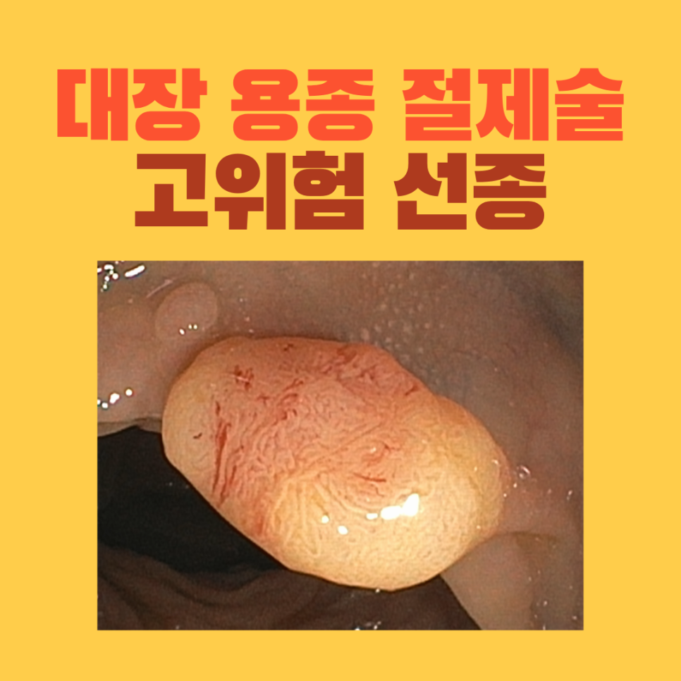 다른 검진에서 남겨진 대장 용종 두 개, 재검사와 절제 후 확인한 고위험 선종
