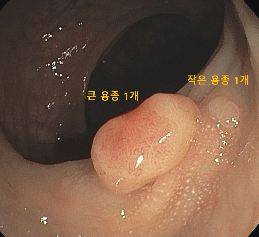 같은 대장 구간에서 큰 용종과 작은 용종이 함께 보이는 내시경 사진