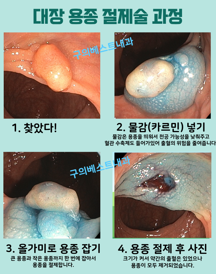 용종 확인과 점막하 주입, 올가미 절제, 절제 후 상태를 순서대로 보여주는 내시경 사진