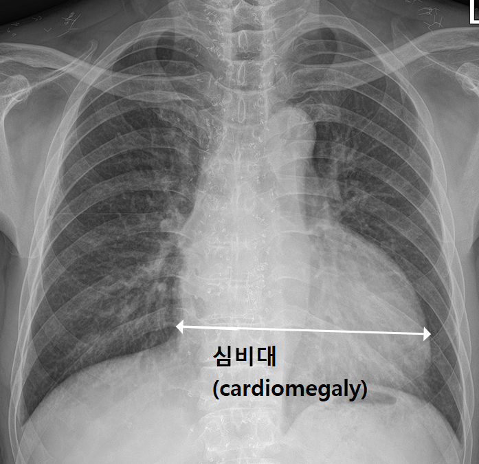 심장 그림자가 크게 보이는 흉부 X선 사진
