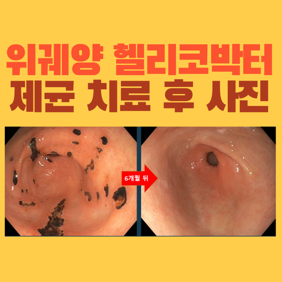 속쓰림으로 발견한 다발성 위궤양, 치료 6개월 뒤 내시경 변화