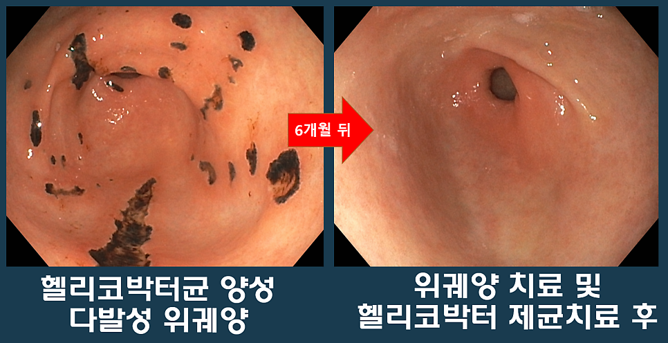 검은 부착물이 보이는 위궤양과 6개월 뒤 점막을 나란히 비교한 내시경 사진