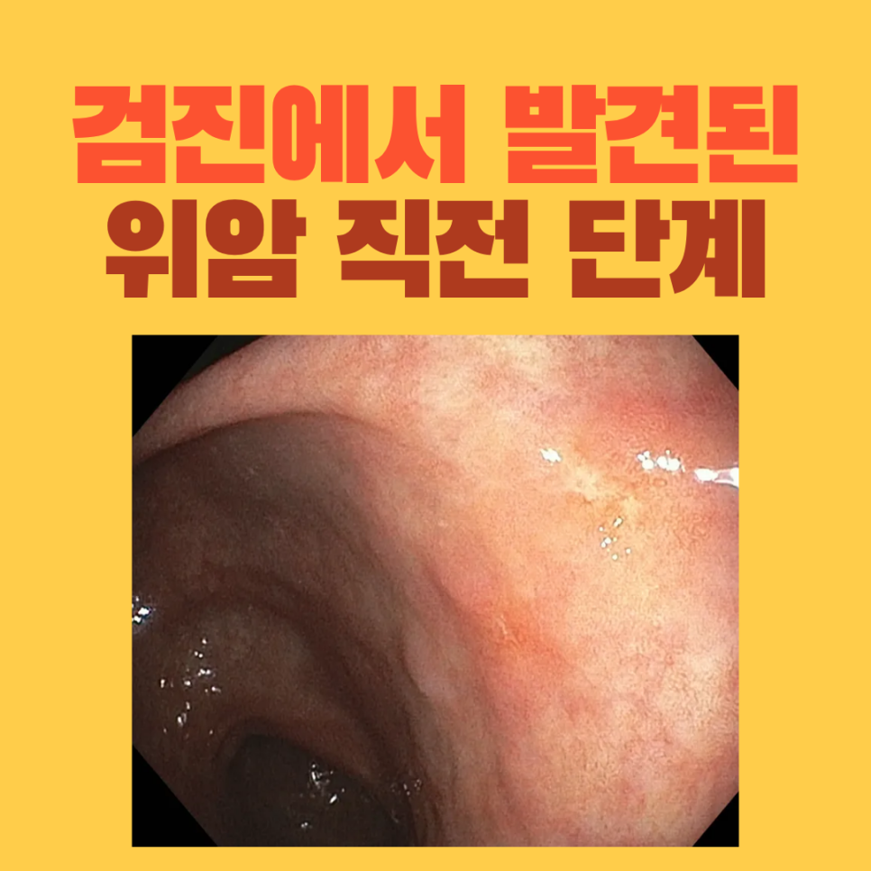 검진 중 발견한 위 선종의 내시경 사진을 담은 원본 표지