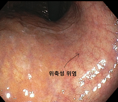 위 점막이 얇아져 혈관이 보이는 부위를 표시한 내시경 사진