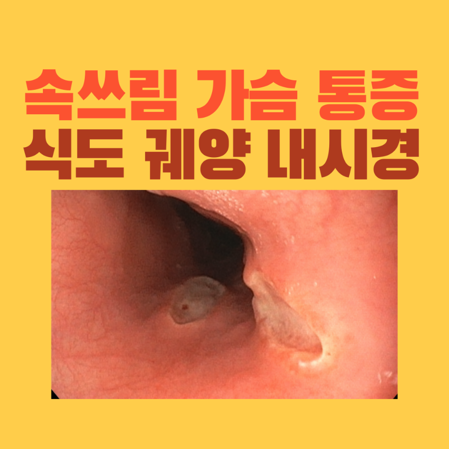 속쓰림과 가슴 통증, 위내시경에서 확인한 식도 궤양