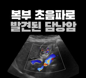 복부초음파에서 발견된 담낭암 의심 종괴를 보여주는 원본 표지