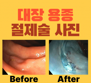 대장 용종 절제 전후 내시경 사진이 배치된 원본 표지