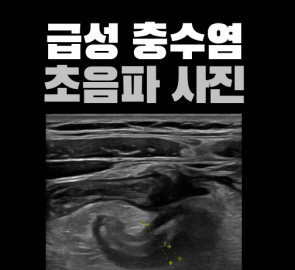급성 충수염의 초음파 영상이 들어간 원본 표지