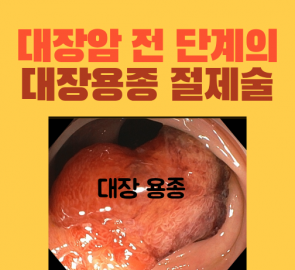 큰 대장 용종 내시경 사진이 담긴 원본 표지