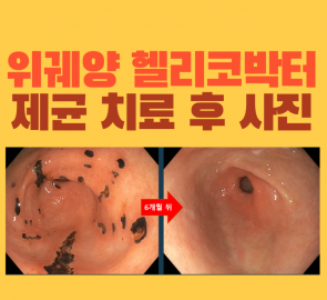 헬리코박터 양성 다발성 위궤양의 치료 전후 내시경 사진을 담은 원본 표지